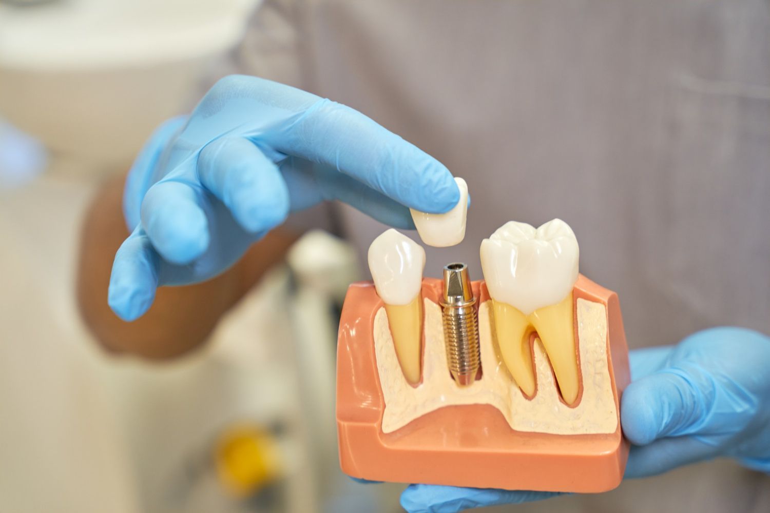 Dental Implant Alternatives