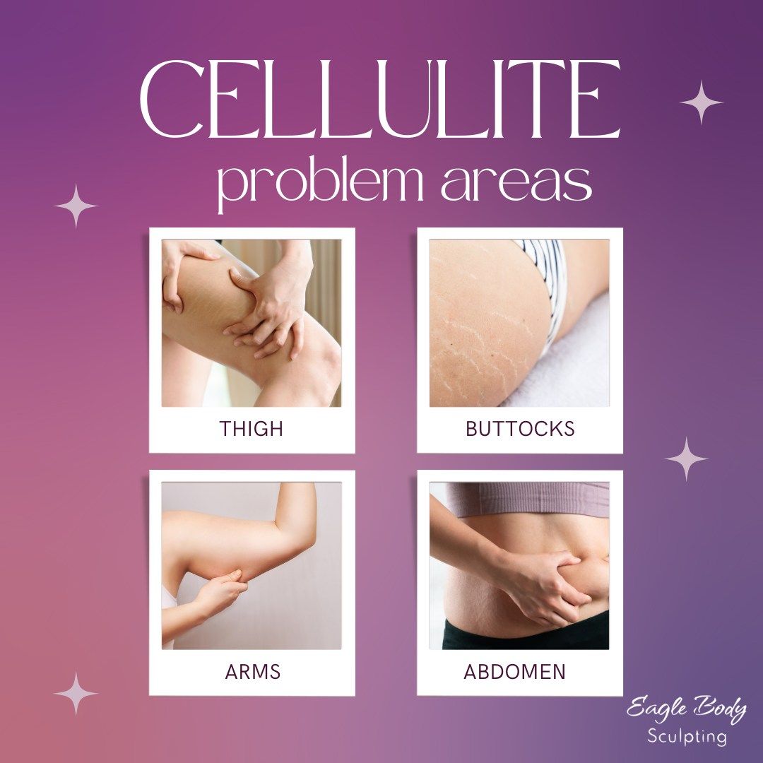 Cellulite problem areas are shown on a purple background