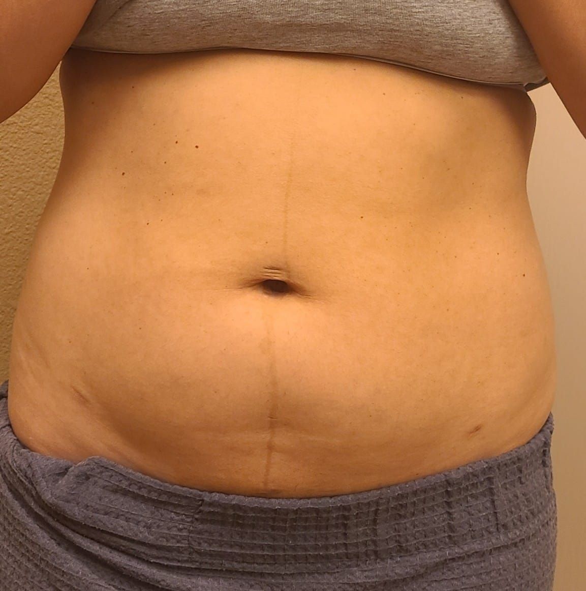 A close up of a woman 's stomach with a few lines on it