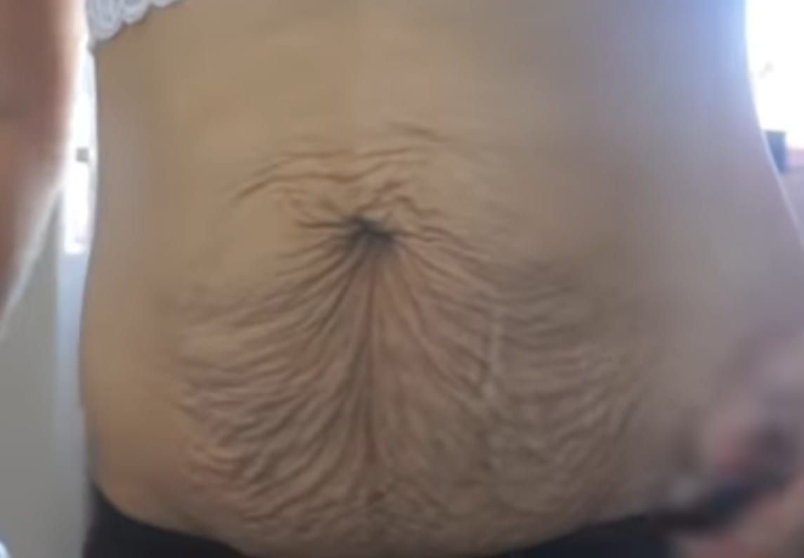 A woman 's stomach has a lot of stretch marks on it