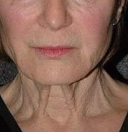 A close up of a woman 's face and neck with wrinkles.