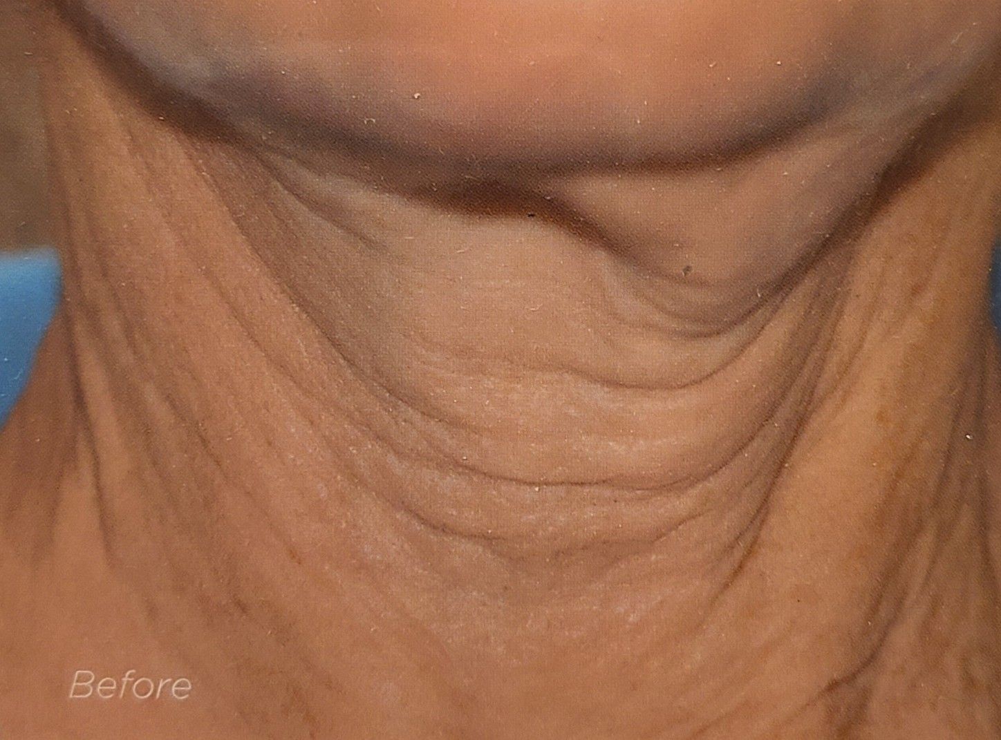 A close up of a woman 's neck with wrinkles.