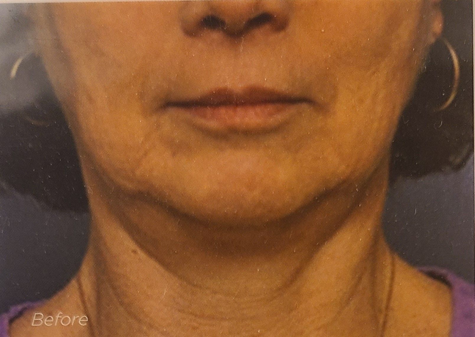 A before and after photo of a woman 's neck and face.