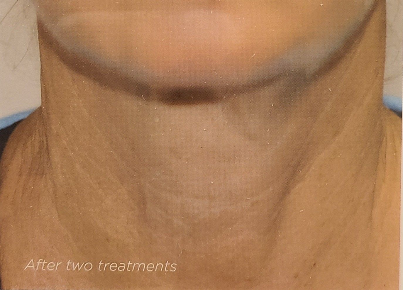 A close up of a woman 's neck after two treatments.
