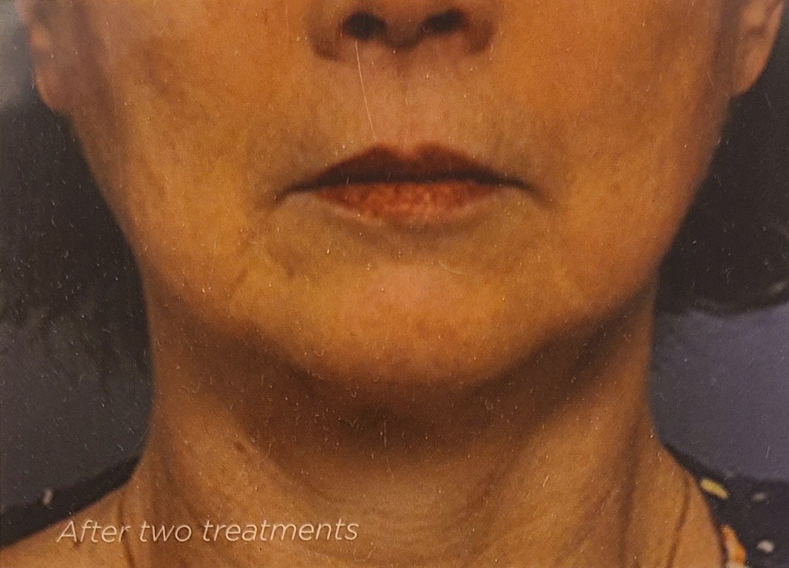 A close up of a woman 's face and neck after two treatments.