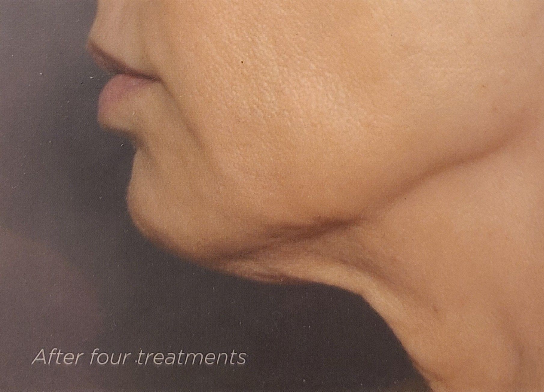 A close up of a woman 's face and neck after four treatments.