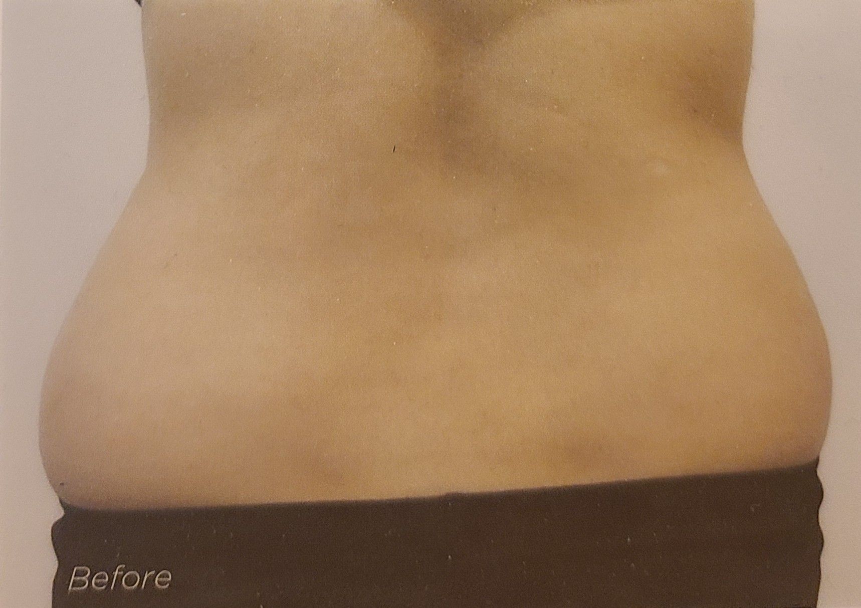 A woman 's stomach is shown in a before and after photo.