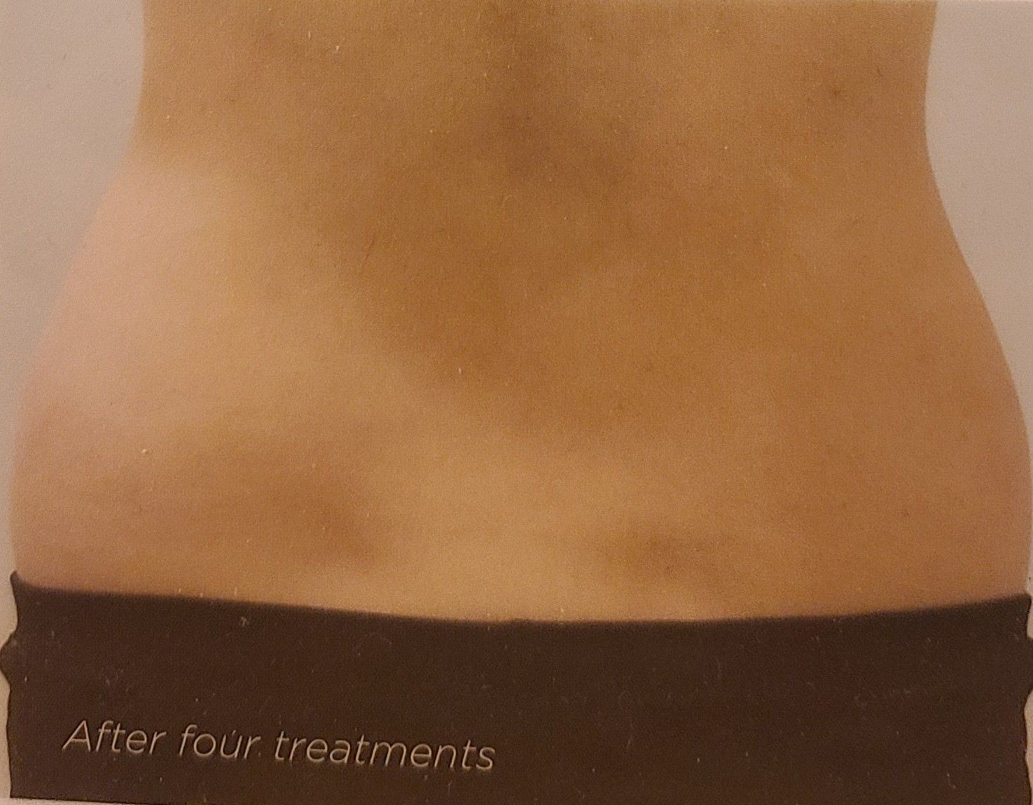A picture of a woman 's stomach after four treatments