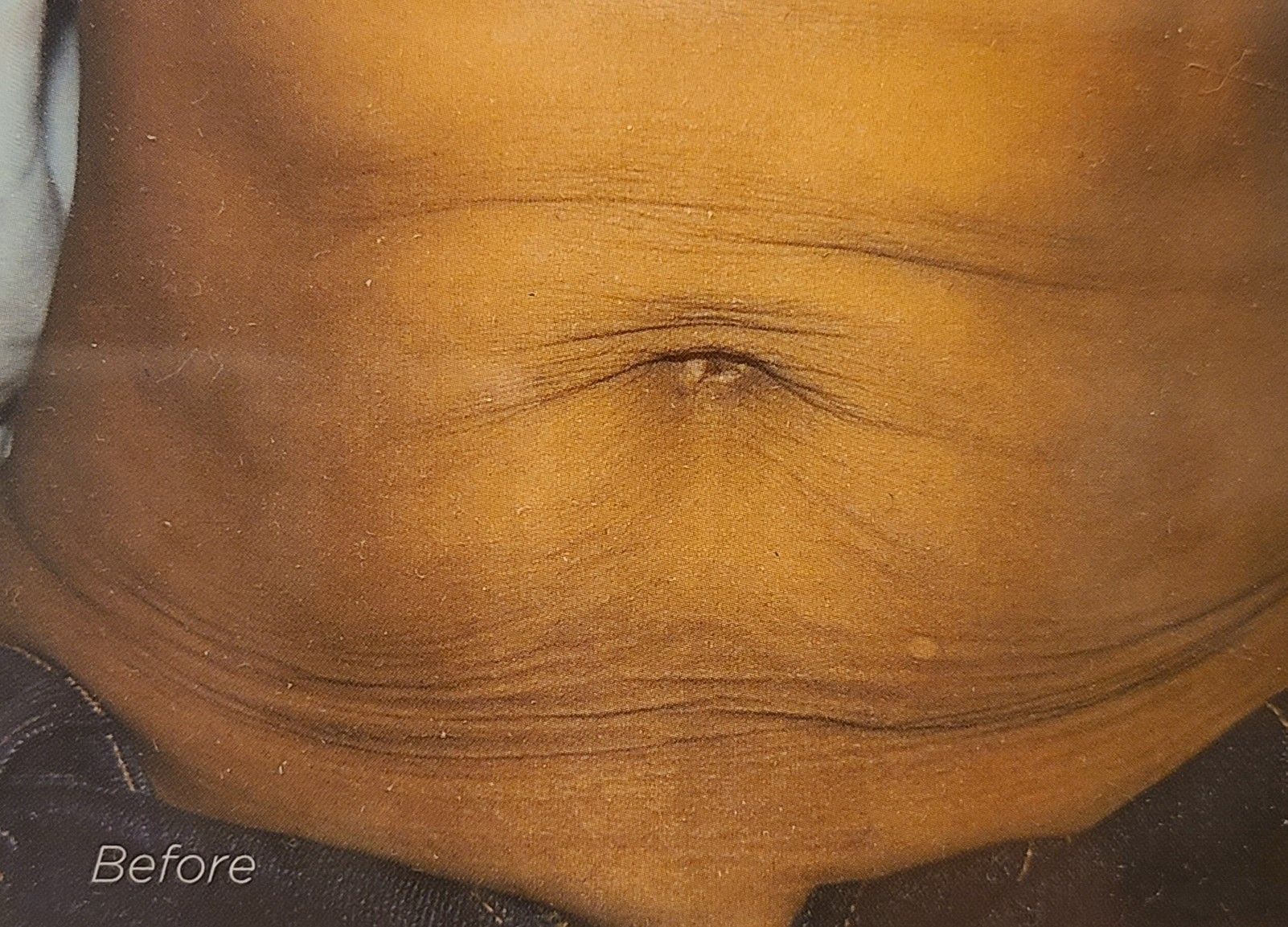 A close up of a woman 's stomach with wrinkles.