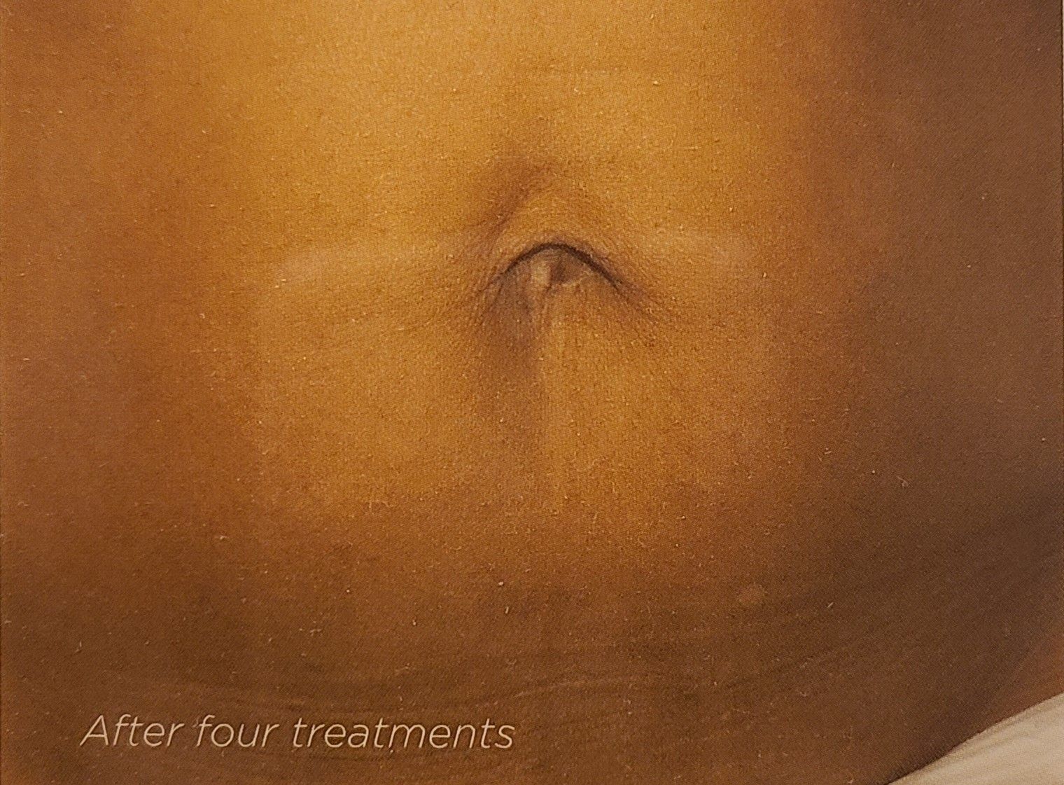 A close up of a person 's belly after four treatments.