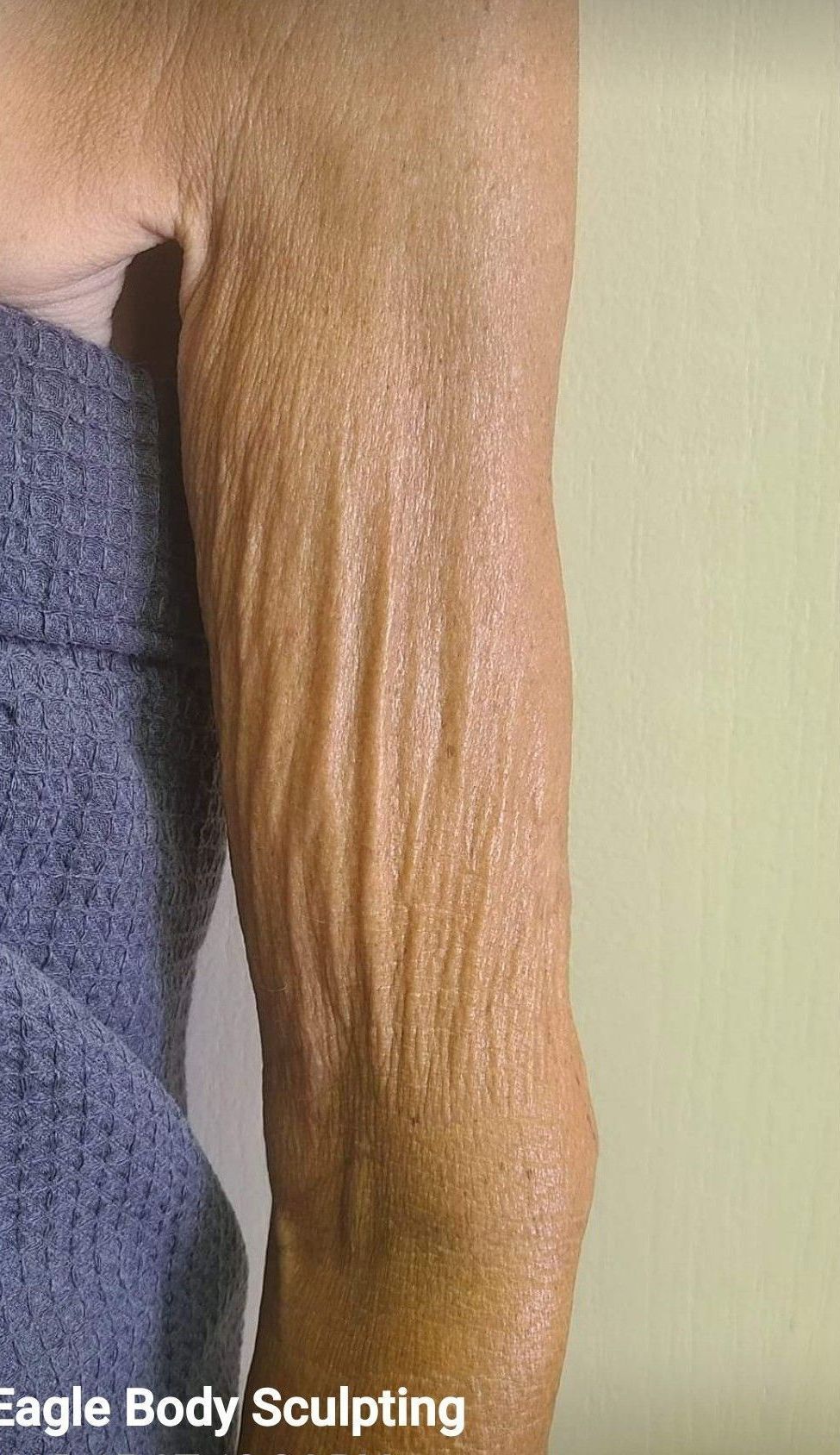 A close up of a woman 's arm with wrinkles.