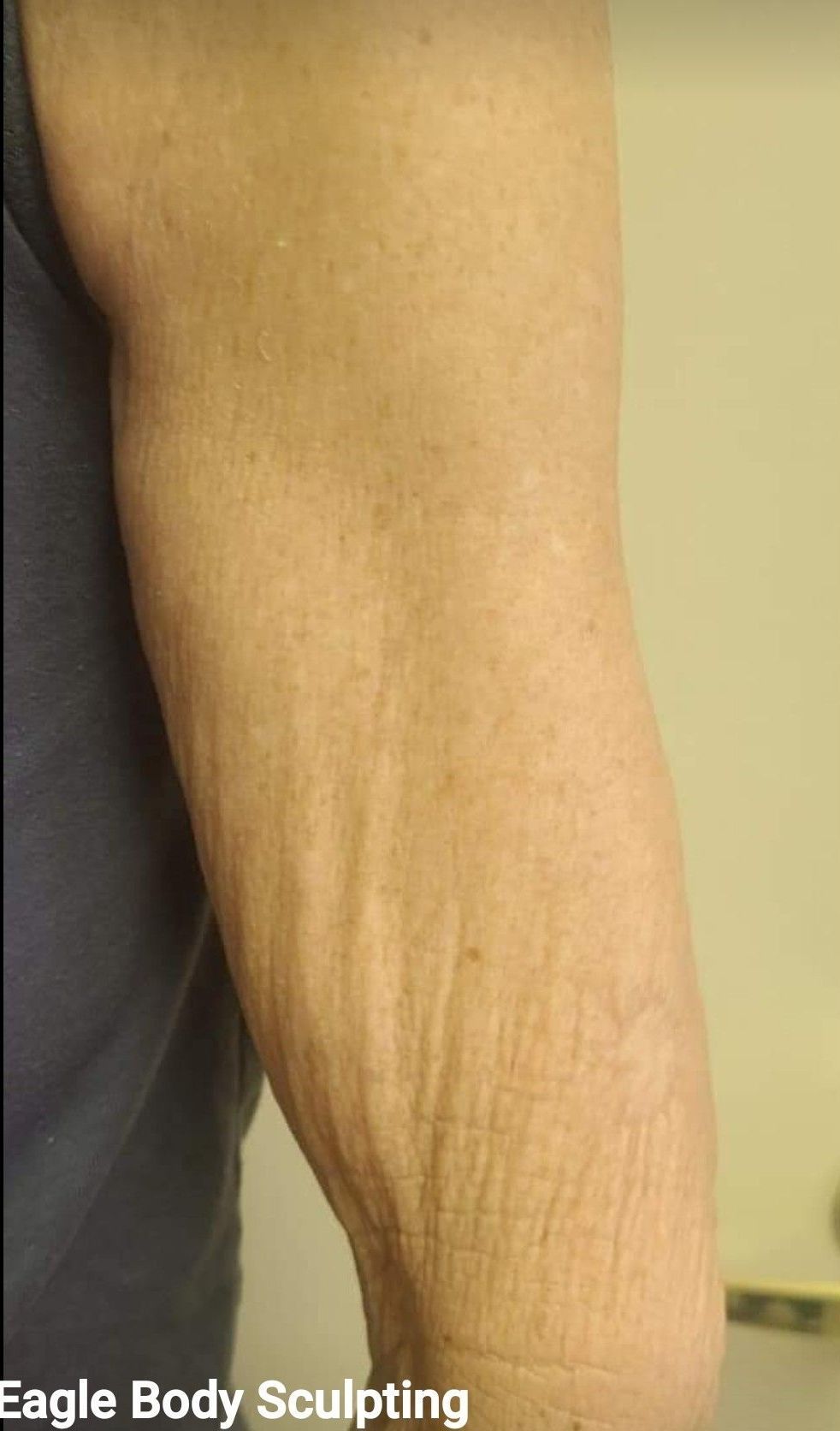 A close up of a person 's arm with the words eagle body sculpting on the bottom