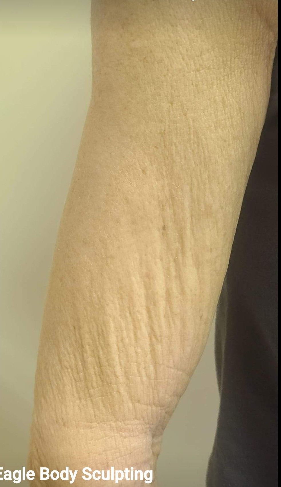 A close up of a person 's arm with wrinkles on it.