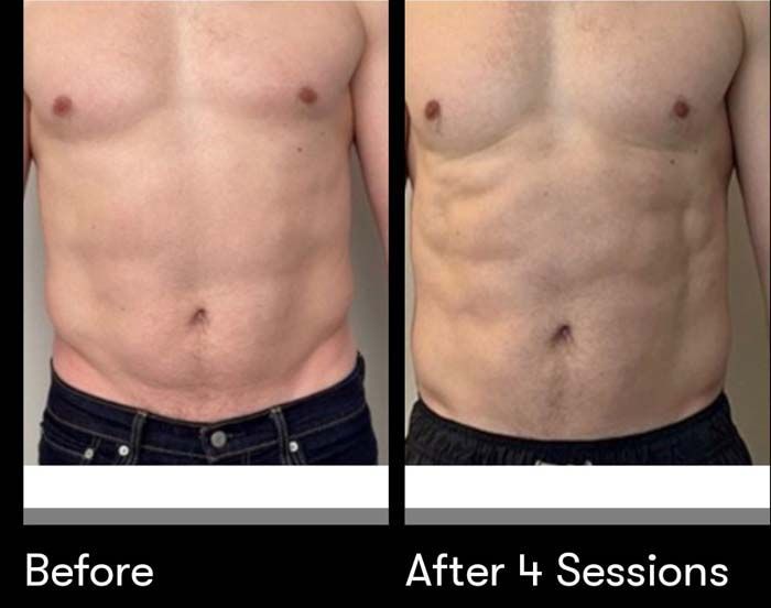 A man 's torso is shown before and after 4 sessions