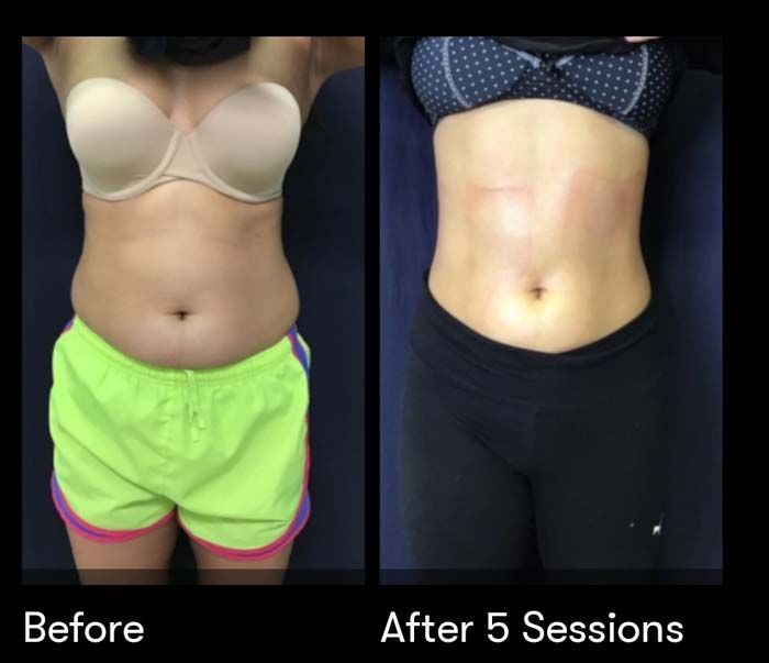 A before and after photo of a woman 's stomach