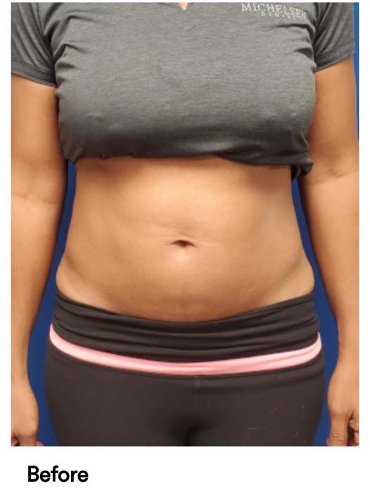 A woman 's stomach is shown in a before photo