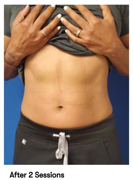 A picture of a woman 's stomach after two sessions