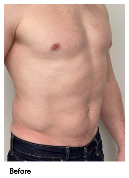 A picture of a man 's torso before surgery