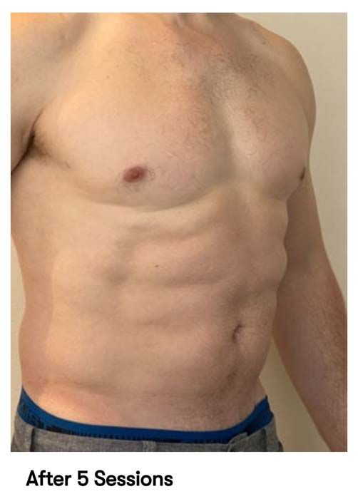A picture of a man 's torso with the caption after 5 sessions