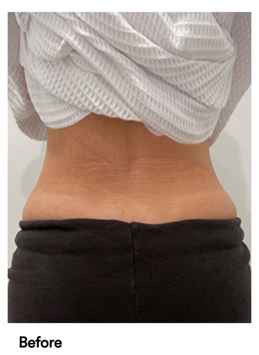 A before and after photo of a woman 's lower back