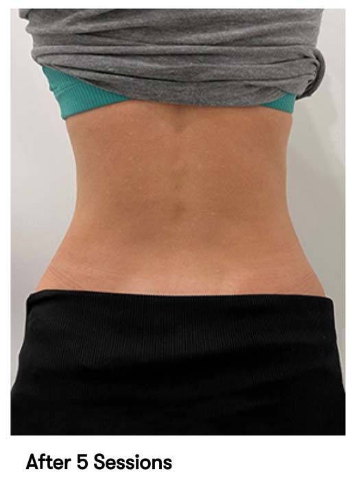 A picture of a woman 's back after 5 sessions