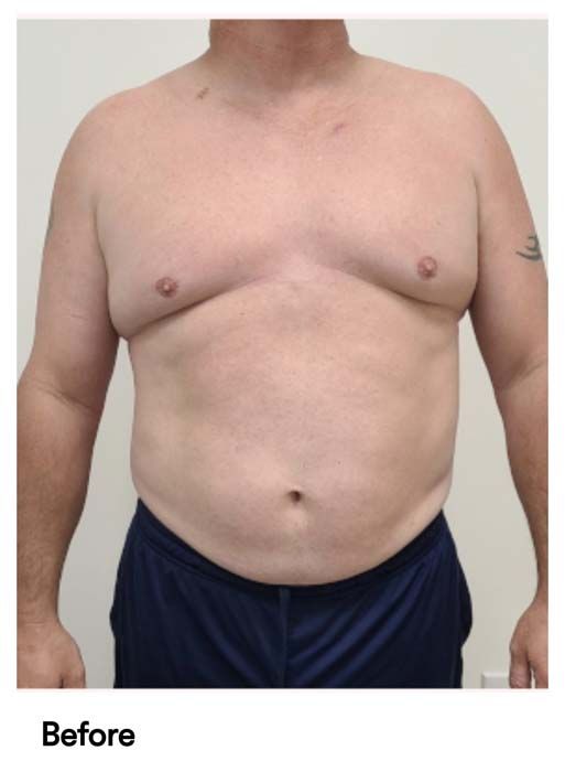 A man 's torso is shown in a before photo