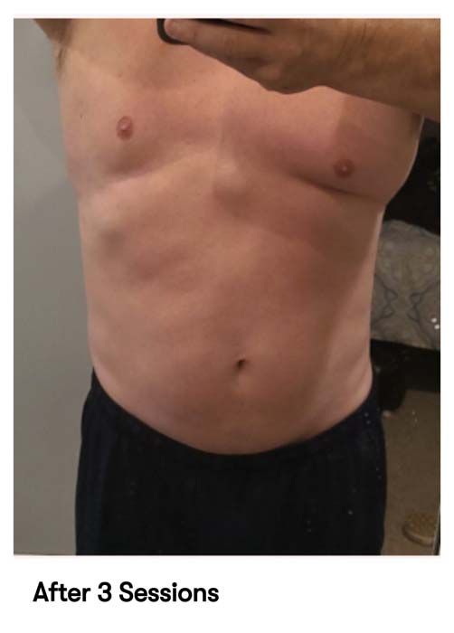 A picture of a man 's torso with the caption after 3 sessions