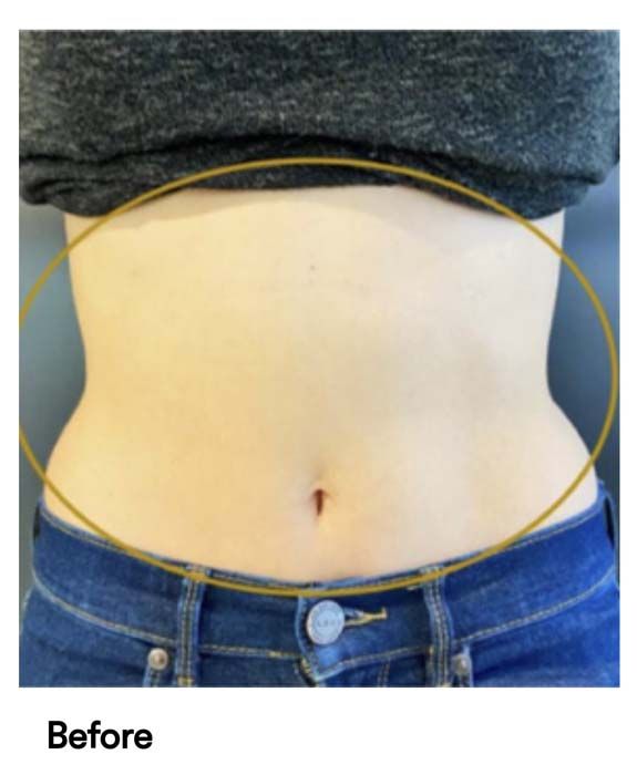 A picture of a woman 's stomach before surgery