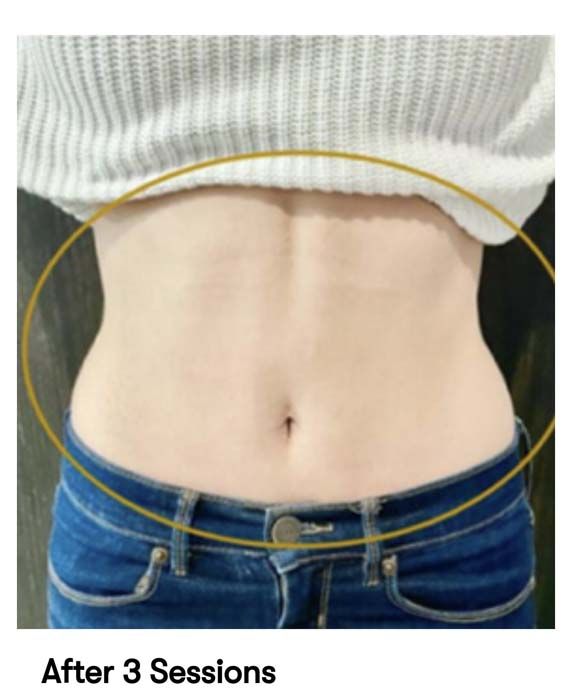 A picture of a woman 's stomach with the caption after 3 sessions