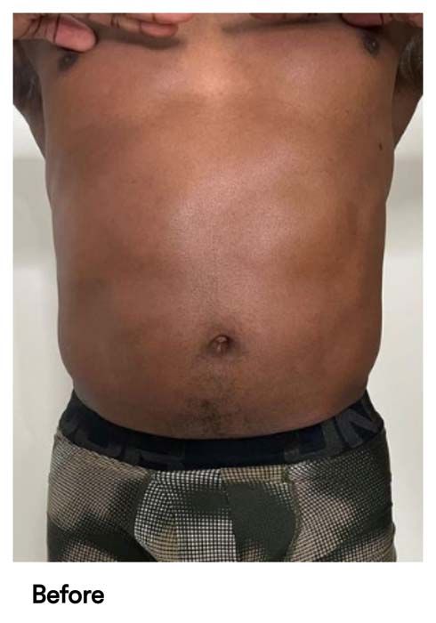 A picture of a man 's stomach before surgery