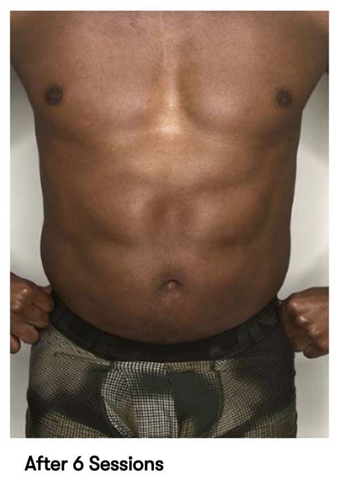 A picture of a man 's torso with the caption after 6 sessions