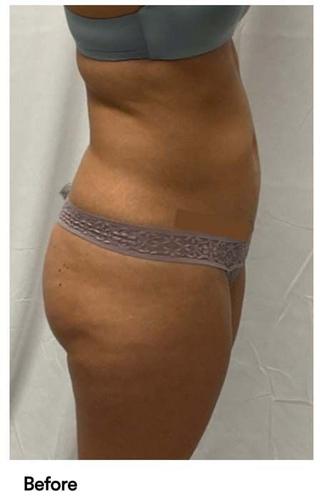 A woman 's torso is shown in a before photo.
