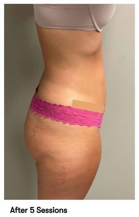 A picture of a woman 's stomach after 5 sessions