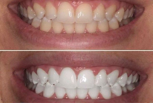 White Teeth — Marlton, NJ — glw GO LIGHTER + WHITER