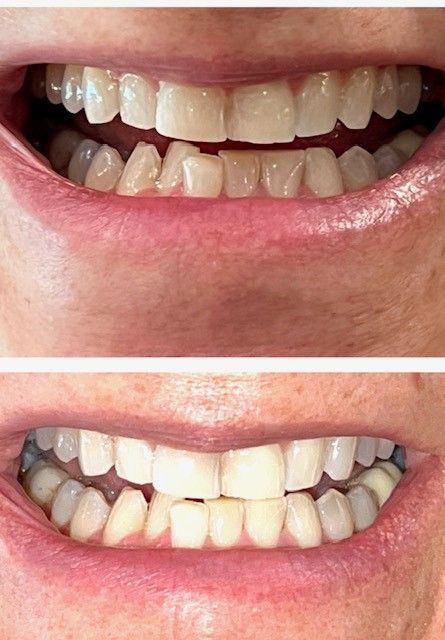 Before and After Teeth Whitening — Marlton, NJ — glw GO LIGHTER + WHITER