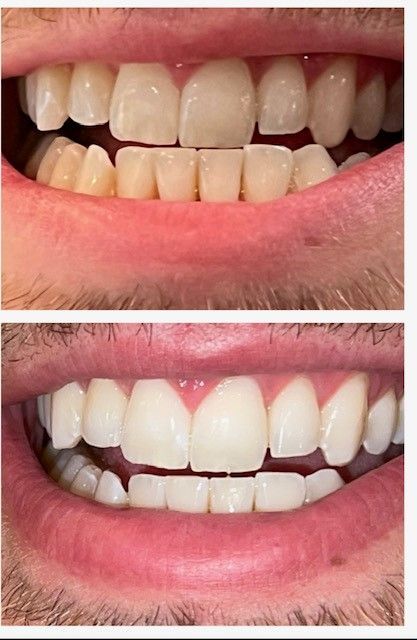 Before and After Whitening — Marlton, NJ — glw GO LIGHTER + WHITER