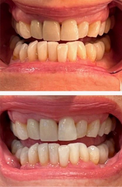 New Set of Teeth — Marlton, NJ — glw GO LIGHTER + WHITER