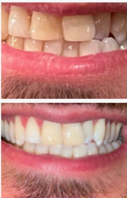 Before and After Happy Smile — Marlton, NJ — glw GO LIGHTER + WHITER