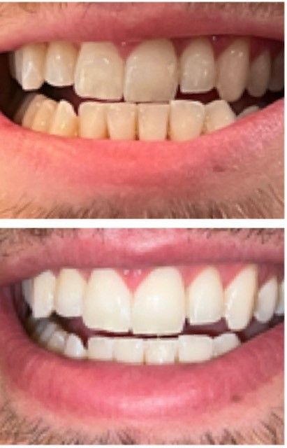 Man's Teeth Before and After — Marlton, NJ — glw GO LIGHTER + WHITER