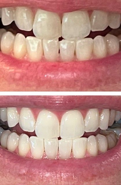 New Teeth Whitening — Marlton, NJ — glw GO LIGHTER + WHITER