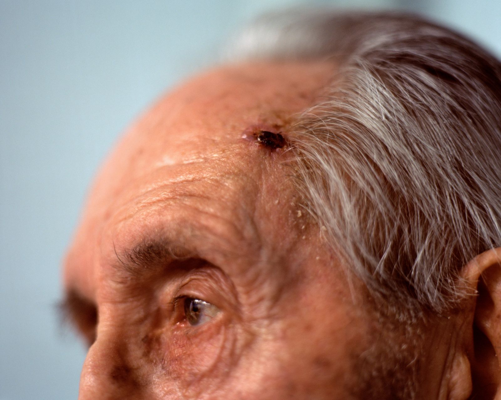 close-up-of-elderly-man-with-skin-cancer-in-the-temple-area