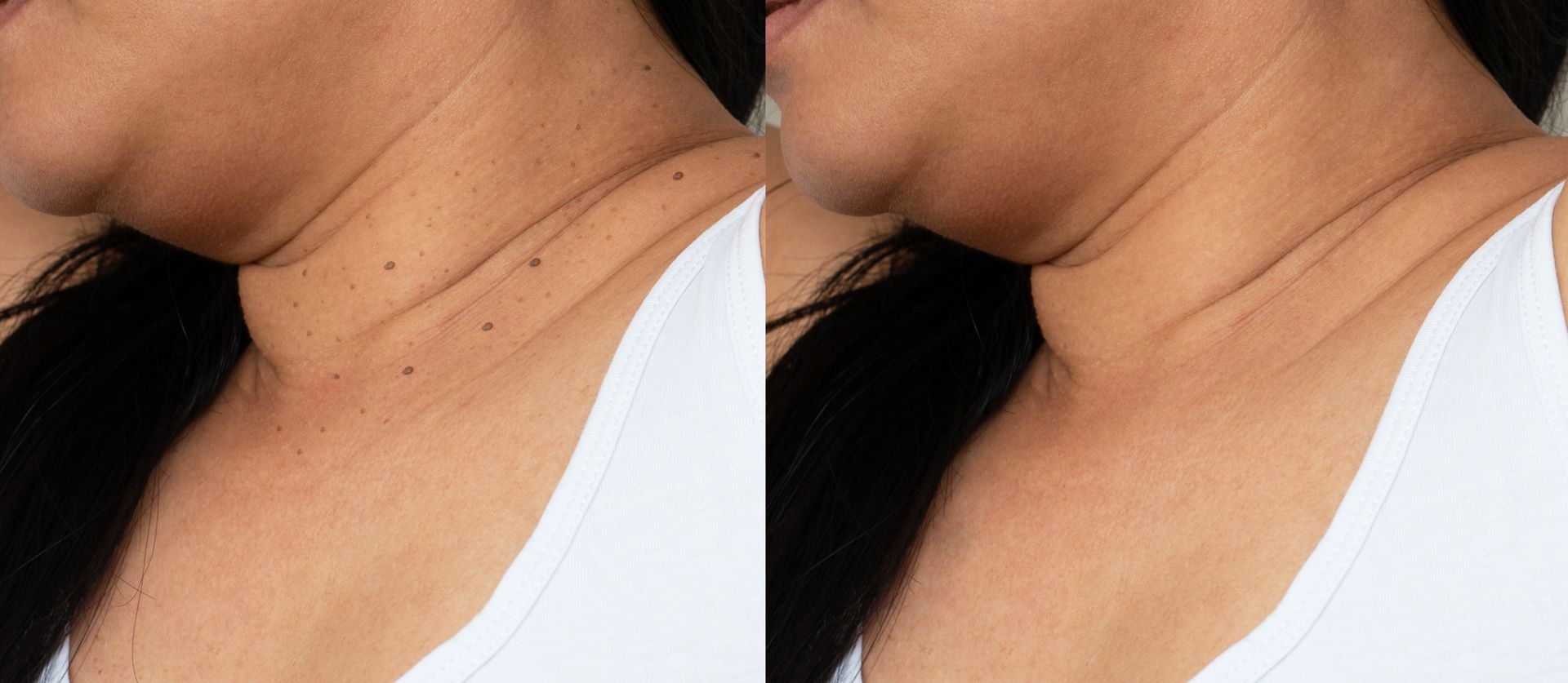 Skin Tag Removal Phoenix