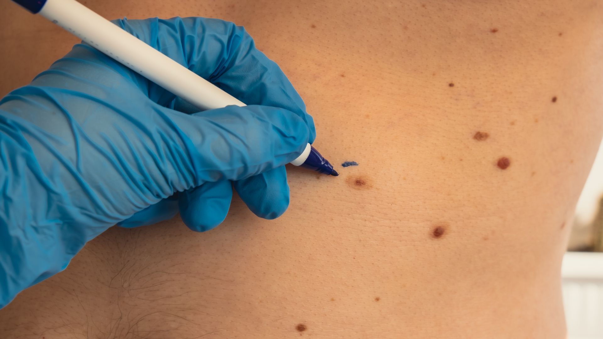 Professional Skin Tag Surgeon