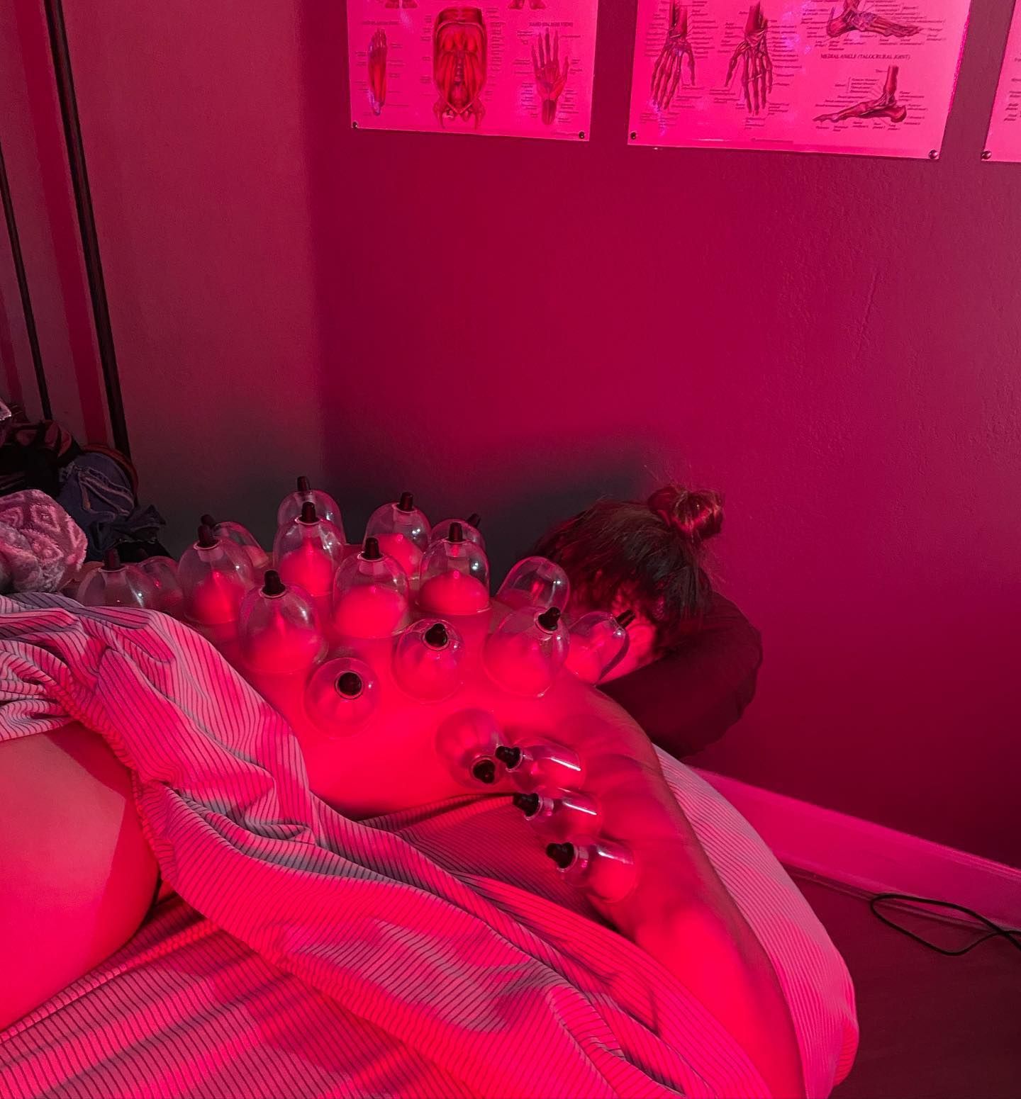 Person receiving cupping therapy on their back, with red light and anatomical charts on the wall.