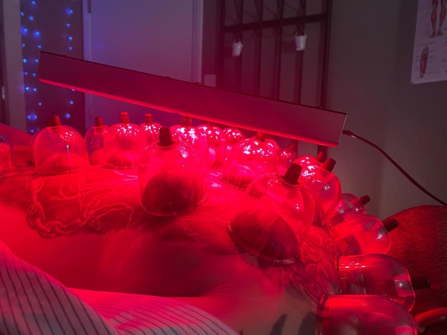 Person receiving cupping therapy, red light shines on cups.