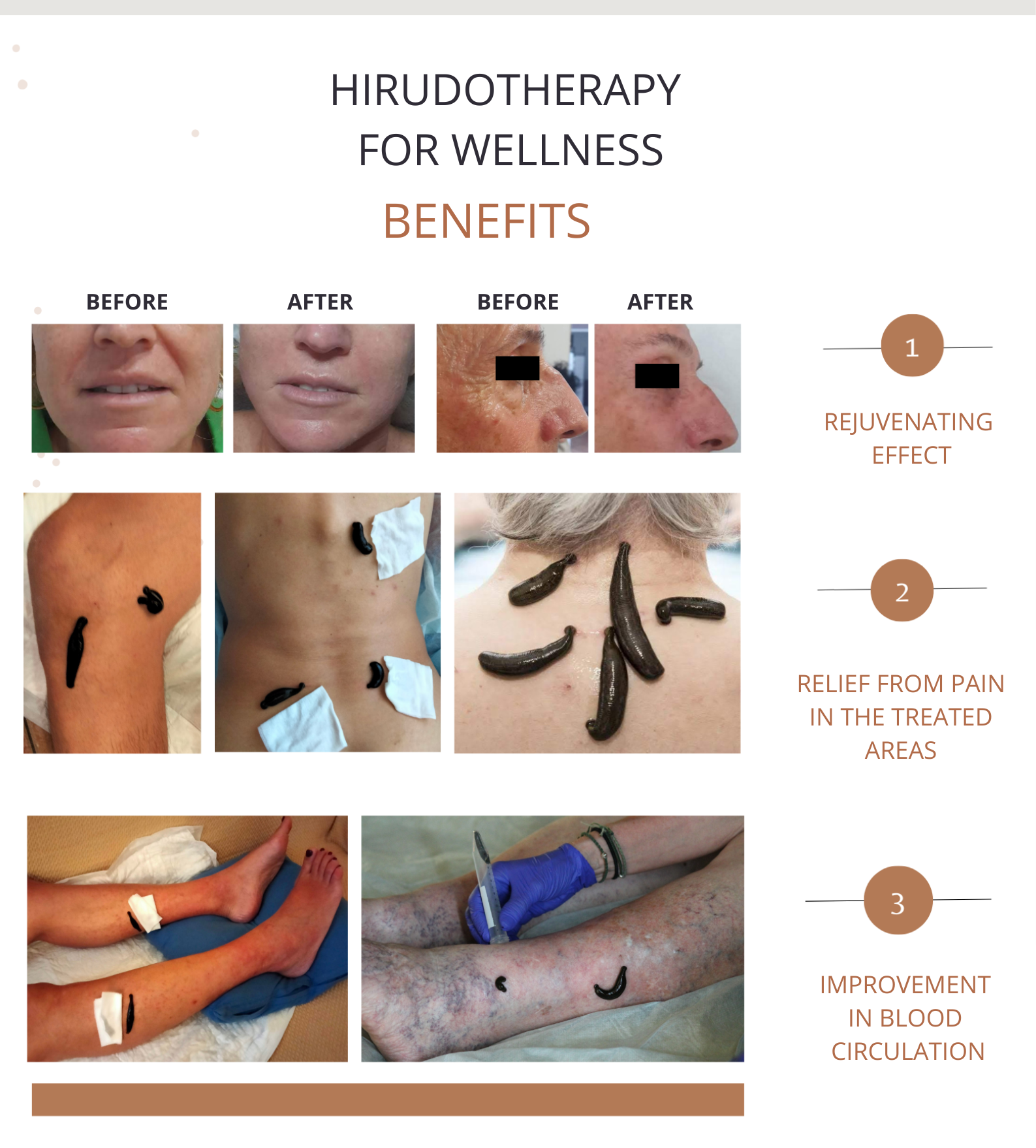 A poster showing the benefits of hirudotherapy for wellness