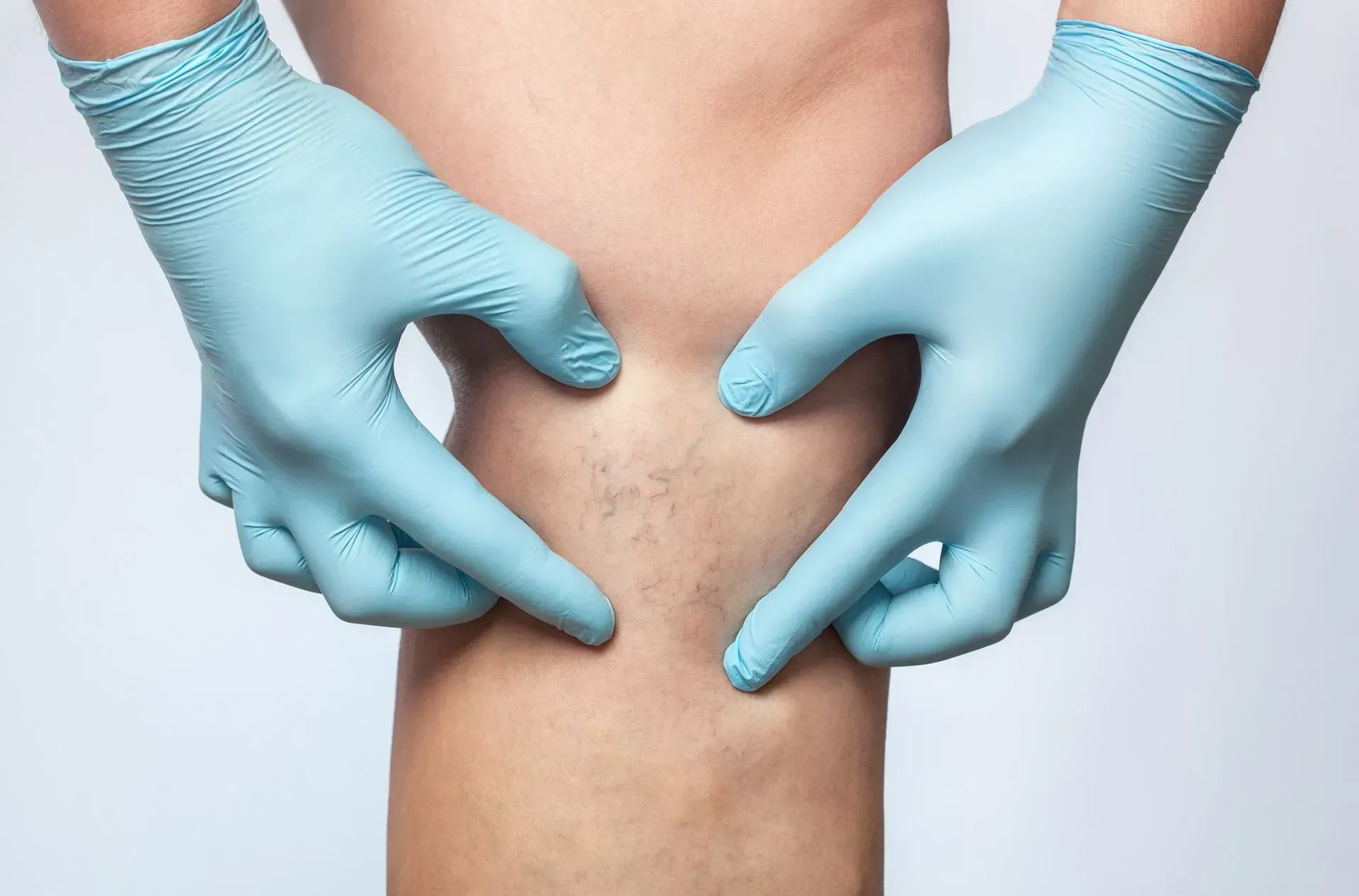Gloved hands pointing to a rash on a person’s thigh