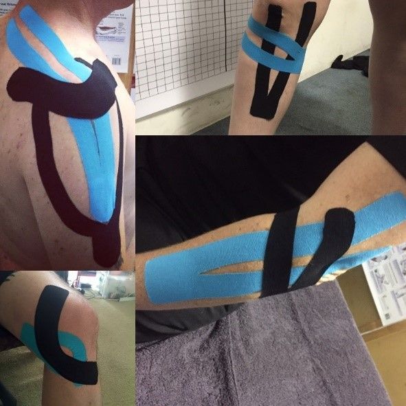 A Woman's Back With Black Tape On It – Chermside, QLD - Hands From Heaven Remedial Therapy Clinic