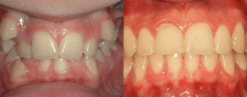 Ortodonzia prima e dopo