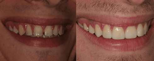 Pulizia dei denti prima e dopo